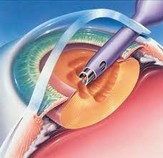phaco emulsification, traitement chirurgical contre la cataracte, Ophtamologie Nancy