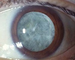 traitement chirurgical contre la cataracte, phaco emulsification, Ophtamologie Nancy